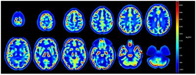 Effect of Point Spread Function Deconvolution in Reconstruction of Brain 18F-FDG PET Images on the Diagnostic Thinking Efficacy in Alzheimer's Disease